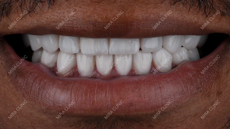 After Veneers